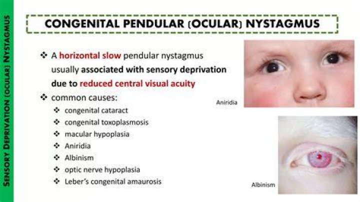 Children with Nystagmus Unable to Recognise Faces Wales Healthcare