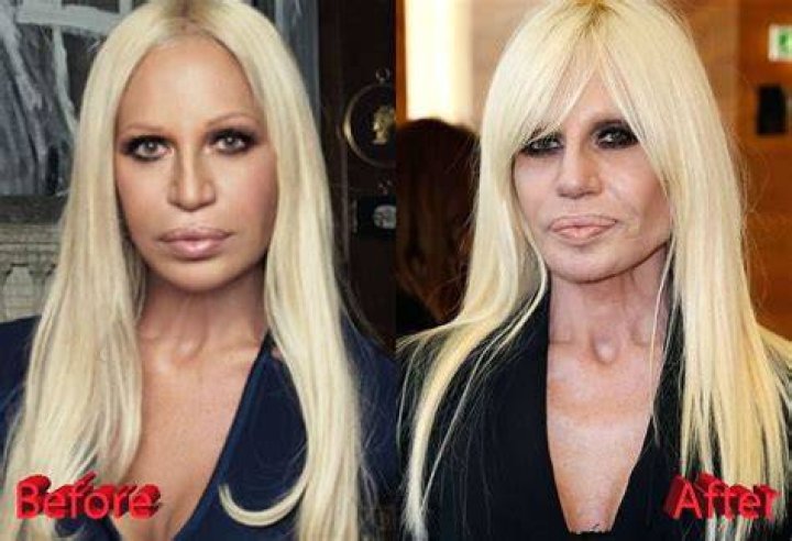 Donatella Versace Before and After Plastic Surgery Vanity