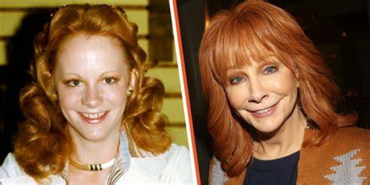 Has Reba McEntire Had Plastic Surgery? A Specialist in the Field Weighs In