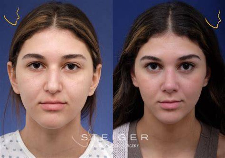 Rhinoplasty before and after Which celebs have had nose jobs from
