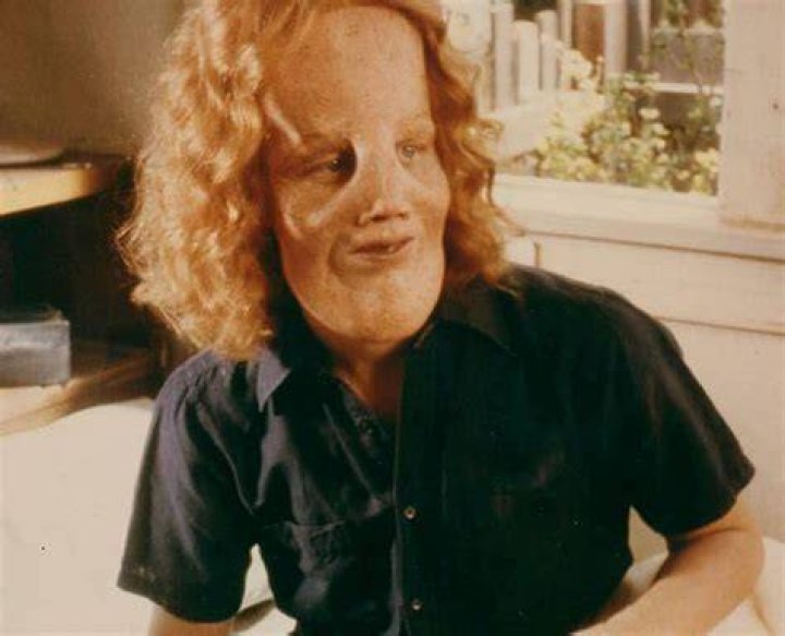 Unveiling The Extraordinary Life And Impact Of Rocky Dennis